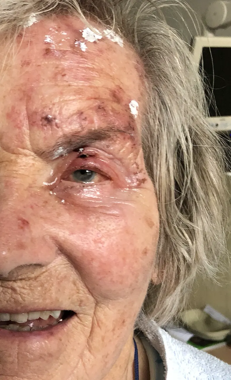 Akute Zoster-ophthalmicus-Läsion im Bereich des ersten Trigeminusastes (Stirn/Auge)
